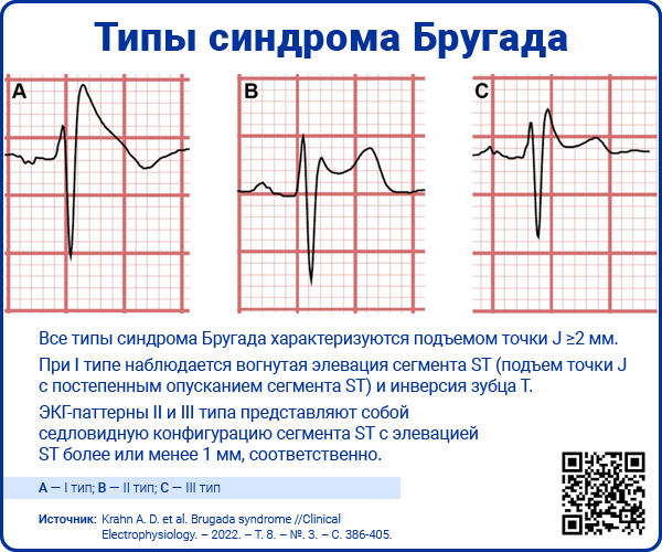 Типы синдрома Бругада